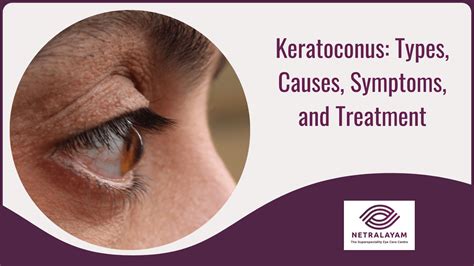 keratoconus thickness how to measure|keratoconus treatment guidelines.